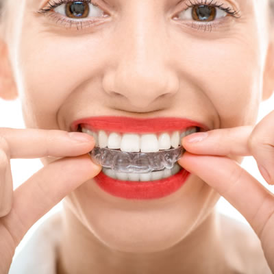 invisalign videos